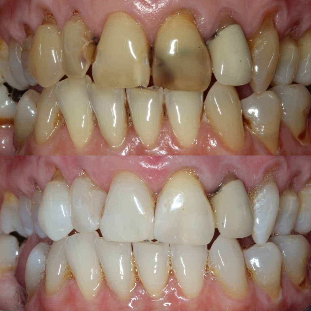 Ravenhill Dental Care Teeth Whitening Ravenhill Dental Care Teeth Whitening