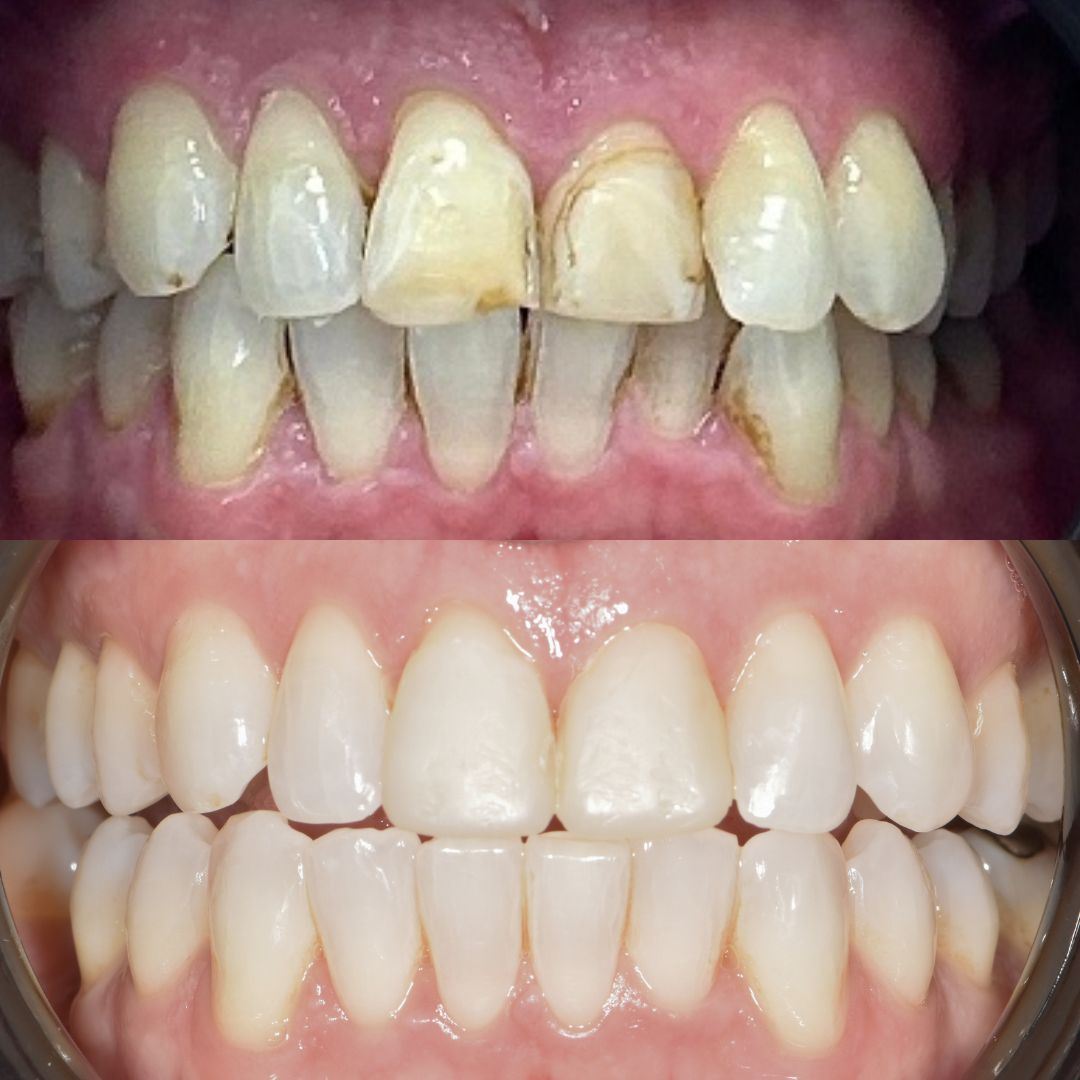 Ravenhill Dental Care Teeth Whitening Ravenhill Dental Care Teeth Whitening