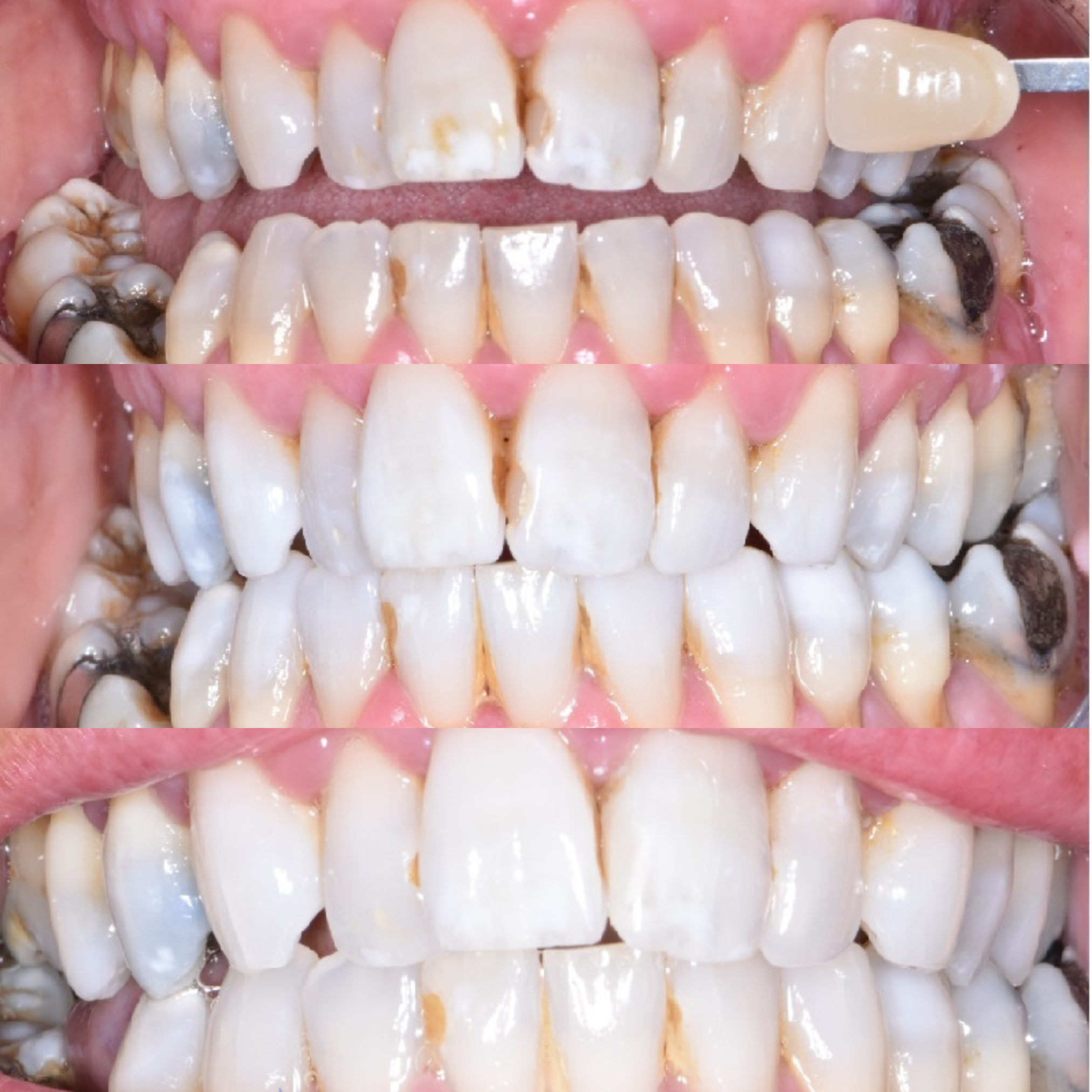 Ravenhill Dental Care Teeth Whitening Ravenhill Dental Care Teeth Whitening